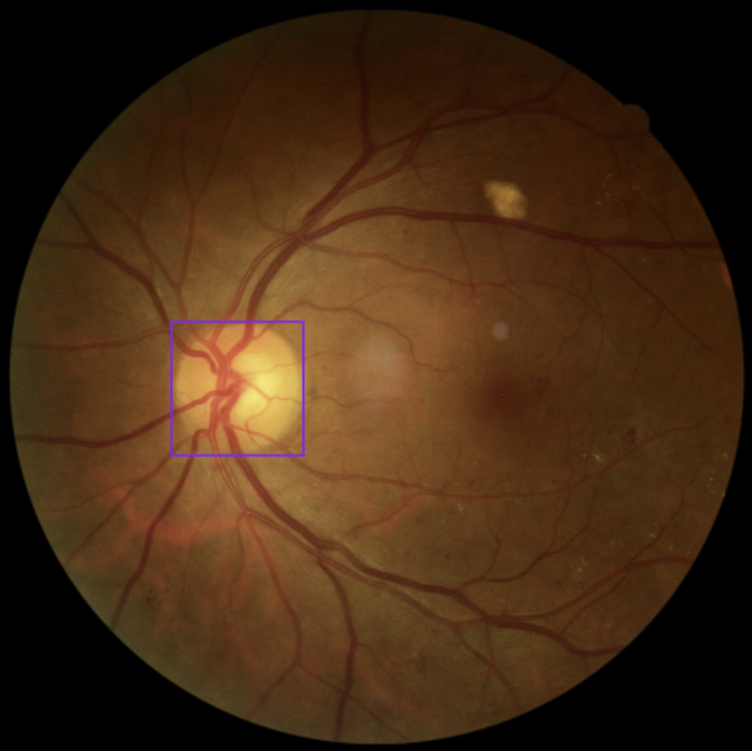 Glaucoma Classification Research